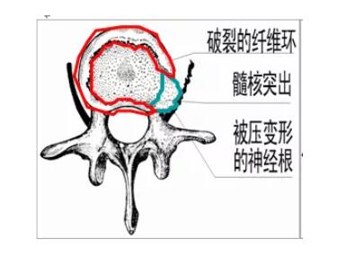 突出髓核压迫神经根.jpg