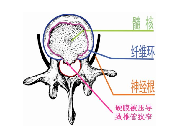 椎管狭窄.png