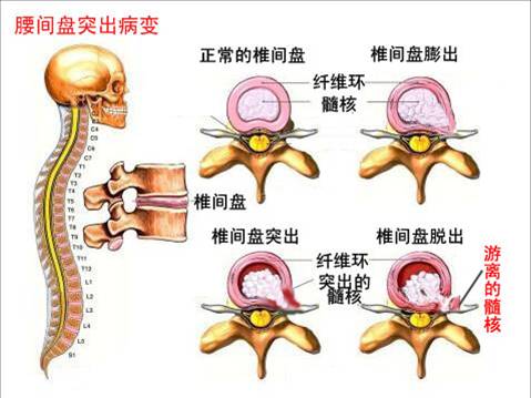 腰间盘突出分类