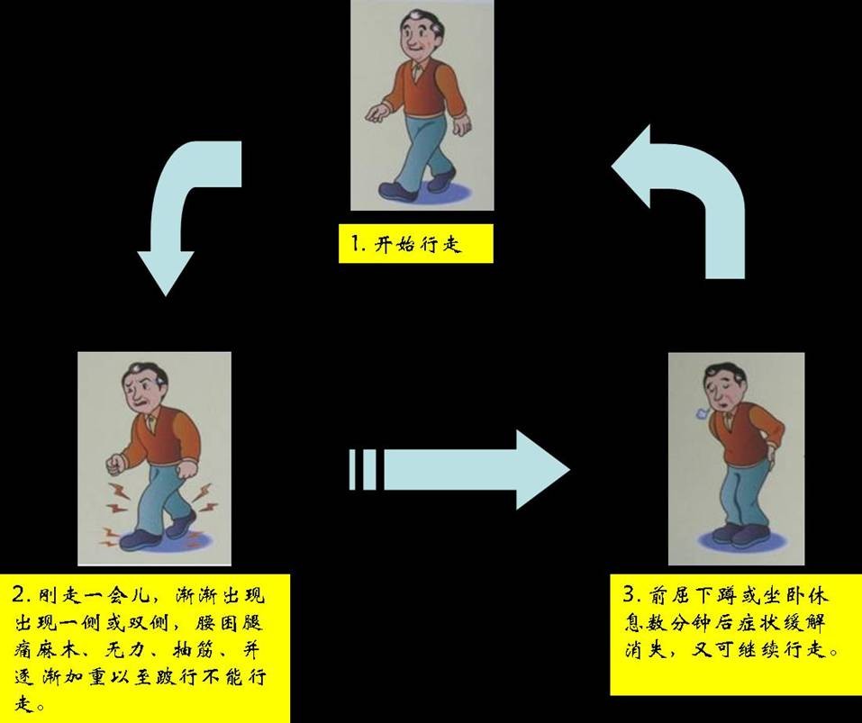 椎管狭窄