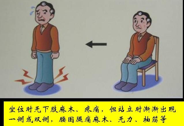 椎管狭窄