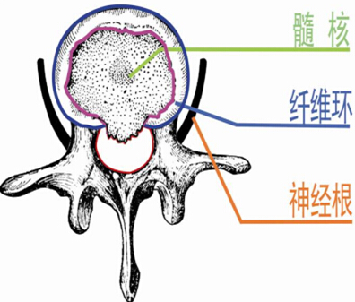 椎管狭窄