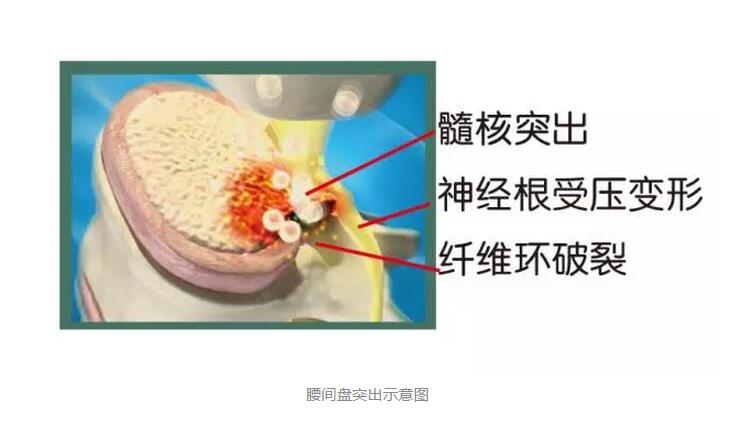 腰间盘突出示意图