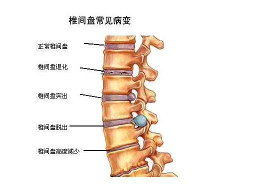 椎间盘退化