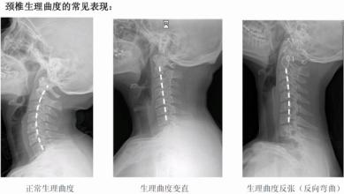 颈椎生理曲度变直