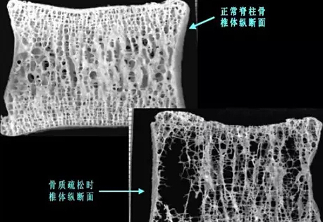 正常的椎骨和骨质疏松的椎骨
