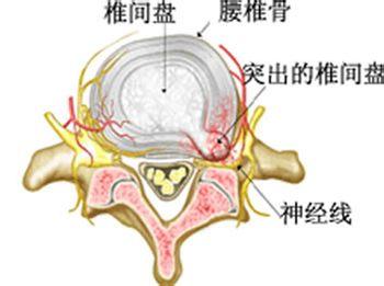 腰间盘突出