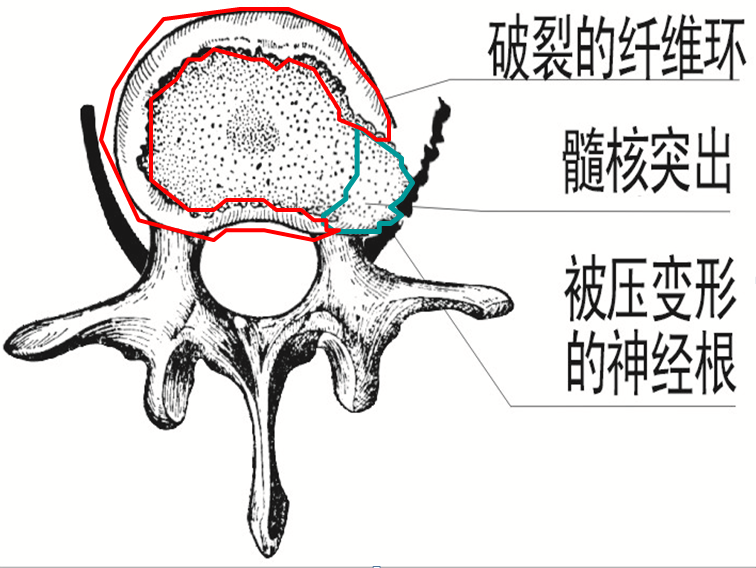 神经根受压变形